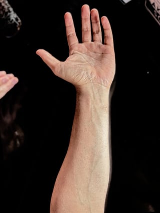 Image of the author's arm and hand, illustrating vascular features beneath the skin. 