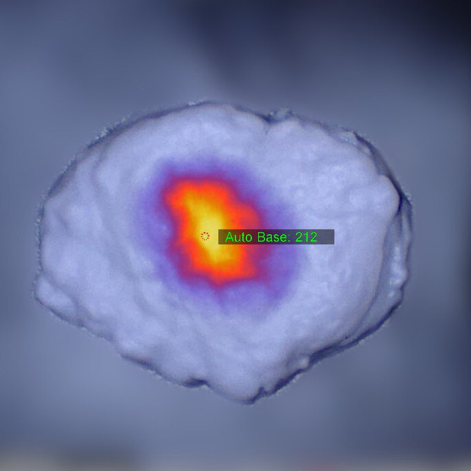 Fluorescence overlay of breast lumpectomy phantom